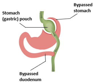 roux en y gastric bypass