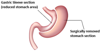 sleeve gastrectomy